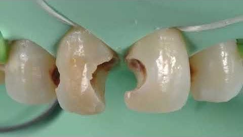 Step by Step Composite  Class III Filling