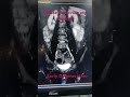 Early degenerative changes in mri ls spine #@3DRadiologystudy