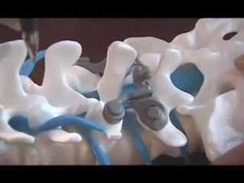 Nonsurgical treatment options for lumbar spinal stenosis - Mayo Clinic