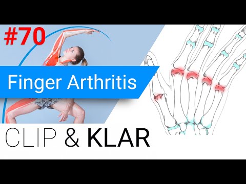 Finger Arthritis erklärt - Rheumatoide Arthritis, Psoriasis und Co.