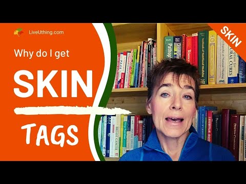 Video: Skin Tags En Diabetes: Wat Is Het Verband?