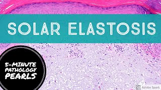 Solar Elastosis: 5-Minute Pathology Pearls