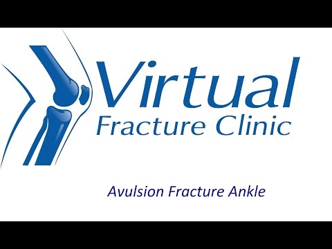 Avulsion fracture to ankle