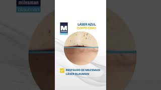 Láser Azul a Coste Cero para tu Centro de Estética #shorts
