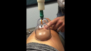 Cupping treatment for knee and thigh pain