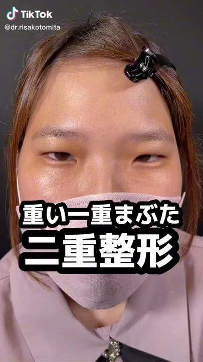 重い瞼も奇麗な二重に