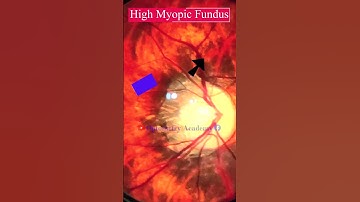 High Myopic Fundus | Fundus Photography | Myopic Crescent | Short Video 297 #viral #optometryacademy