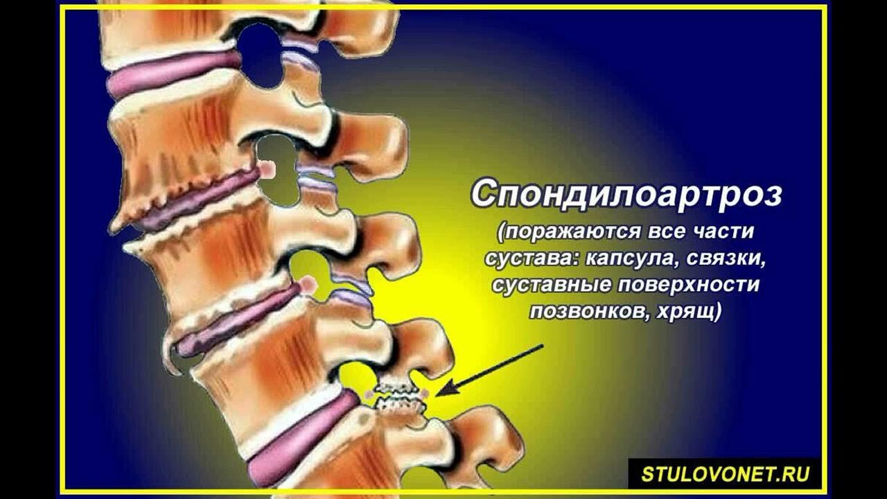 Остеохондроз заболевание суставов. Спондилоартроз с6-th1. Спондилез позвоночника. Спондилоартроз c3/c4. Спондилоартроз th5 - th12..