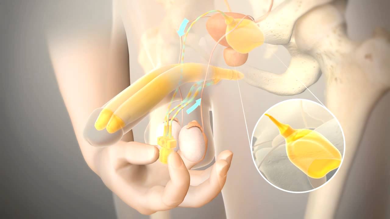Animation   3 Piece Penile Prosthesis