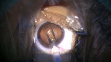 EVO Visian® Toric ICL™ Implantation