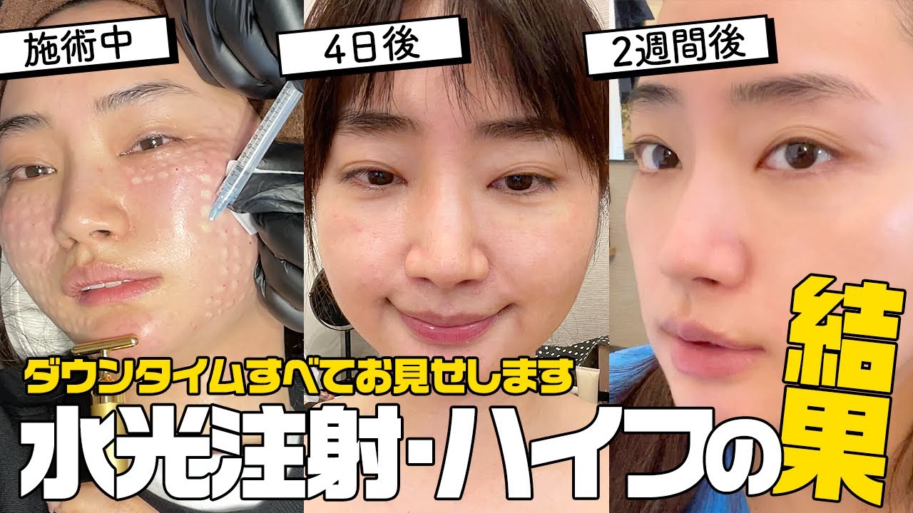 【激変】たるみ治療とツヤ美肌を手に入れる韓国美容医療【水光注射/ハイフ/ボトックス】