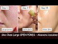 She rubs Aloevera ice cubes Daily & Closed LARGE OPEN PORES | Damaged Skin Repair | Skin whitening