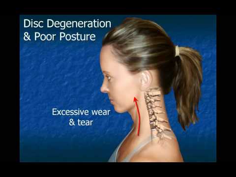 Cervical Disc Degeneration