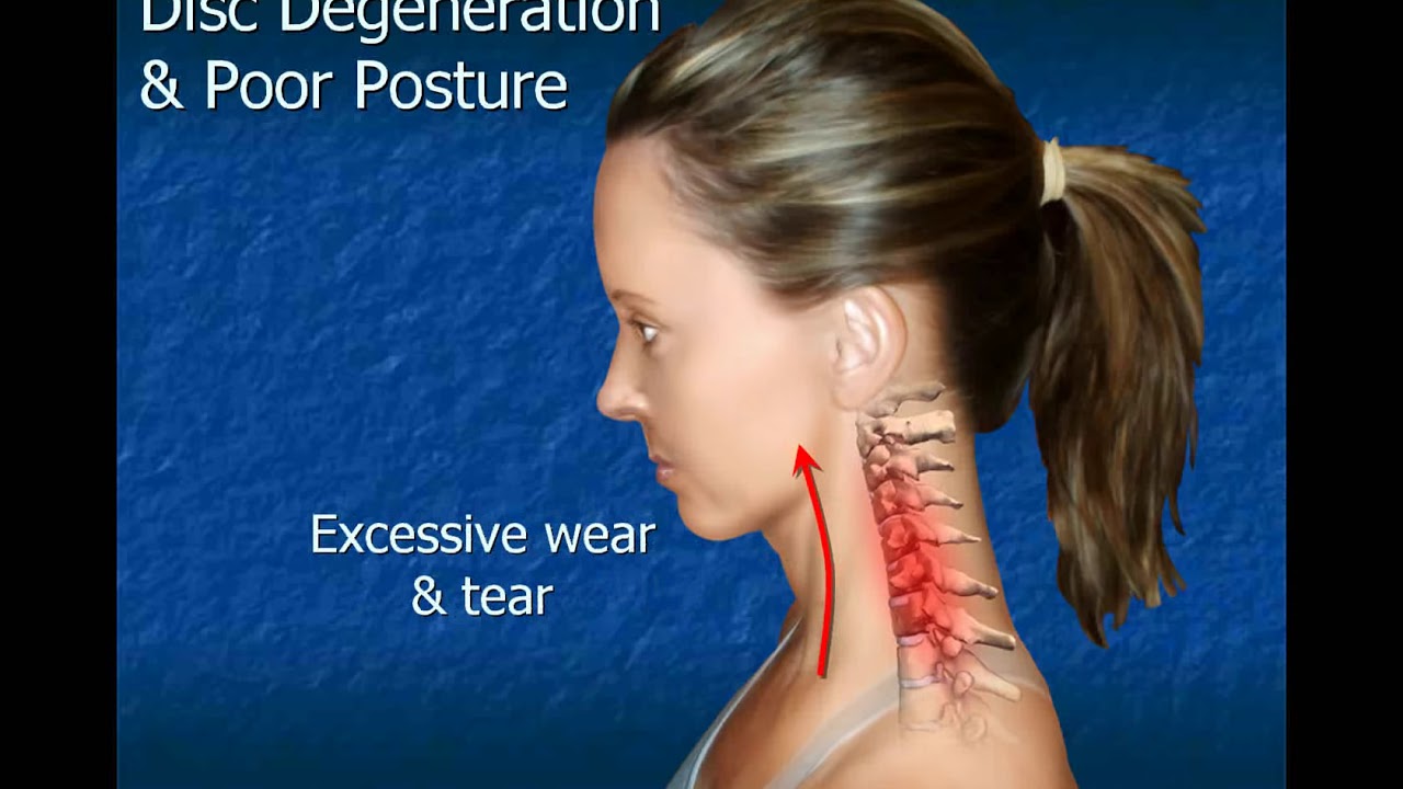 Cervical Disc Degeneration YouTube