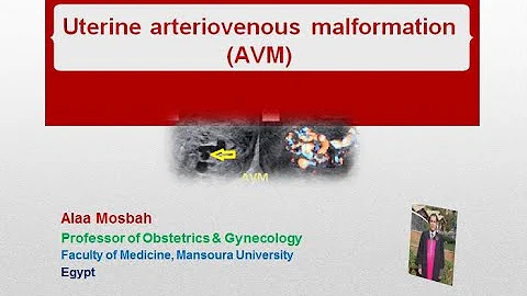 Uterine arteriovenous malformation (AVM)