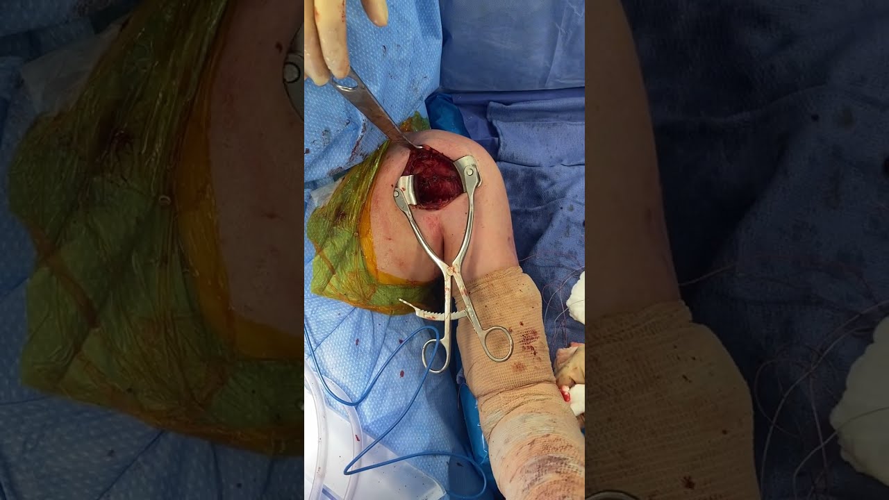 Subscapularis Repair After Open Stabilization