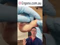 Say Goodbye to Painful Callus &amp; Corn Between Toes Expert Tips &amp; Solutions #FootCare #HealthyFeet