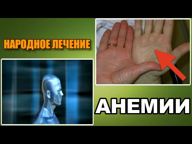 АНЕМИЯ. МАЛОКРОВИЕ. ЛЕЧЕНИЕ АНЕМИИ НАРОДНЫМИ СРЕДСТВАМИ