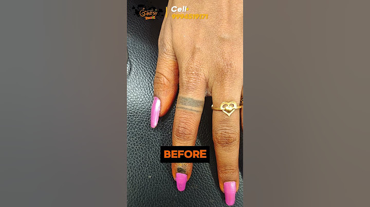 Tattoo Removal |finger tattoo |permanent tattoo removal |tattoo removal trichy