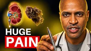 Kidney Stones: The Painful Warning Your Metabolism May Be Sending