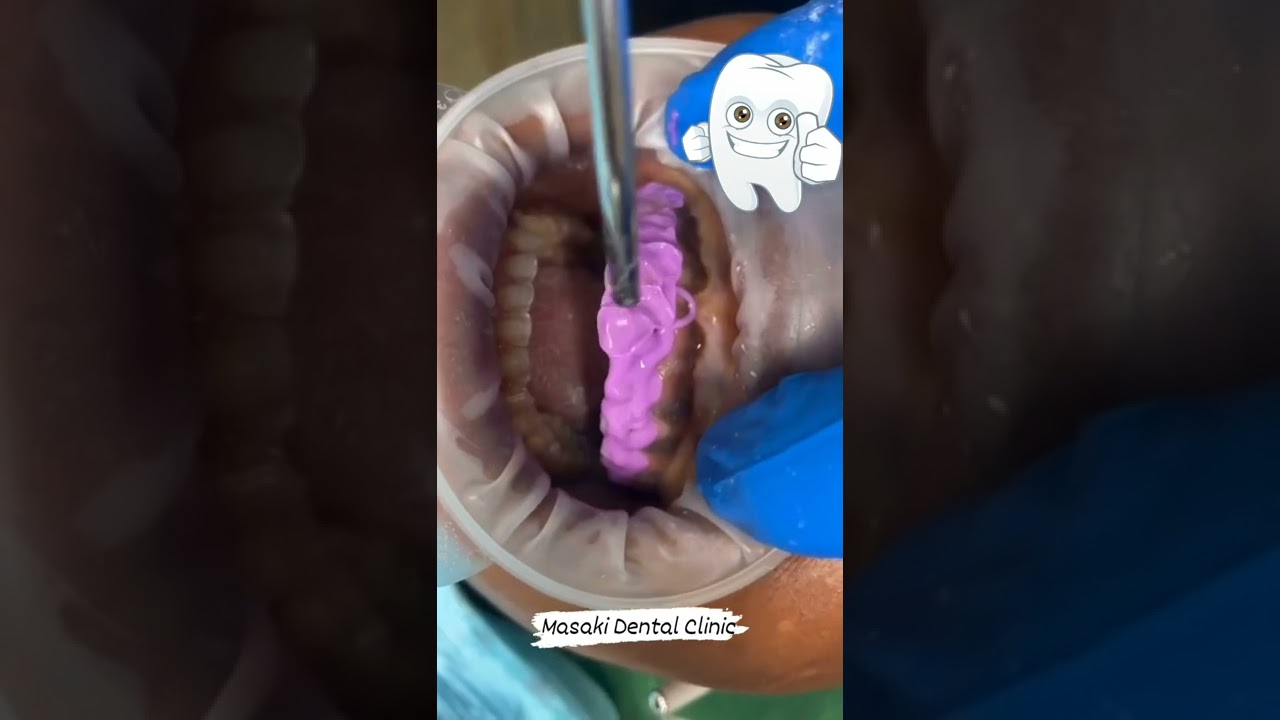 Teeth whitening process Johnny depp 