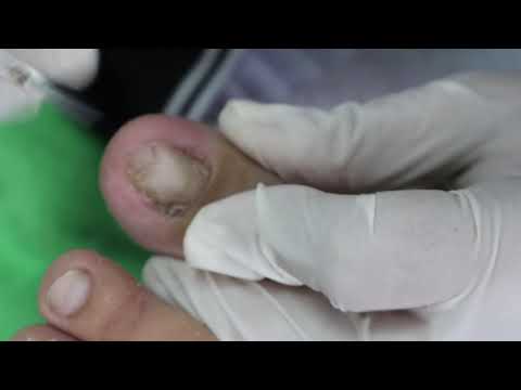 Ep_2789 Foot nails skin removal 👣 ตัดหนัง..ตัดยังไงให้เรียบ? 😷 (This clip is from Thailand)