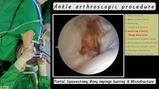 479.(의사용.Surgery.Integration 40min.) Ankle arthroscopy: Portal, Synovectomy, Burring, Microfracture