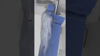 Removal Of Kidney Stones Pcnl