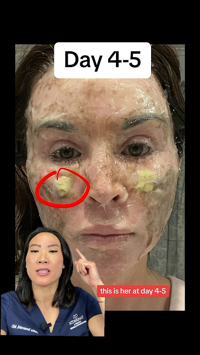 This Is CO2 Laser Recovery (BEFORE AFTER)