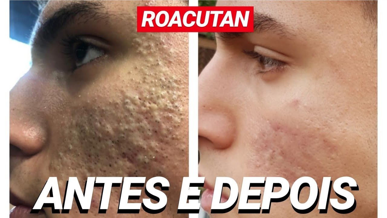 O FIM DO TRATAMENTO COM O ROACUTAN! Antes e Depois! - YouTube