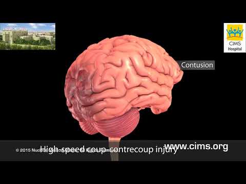 वीडियो: एक टीबीआई (दर्दनाक मस्तिष्क की चोट) से वसूली का प्रबंधन कैसे करें