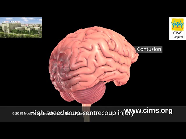 Mild Traumatic Brain Injury (Hindi) - CIMS Hospital