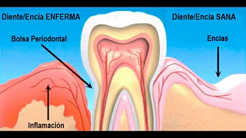 ¿Qué es la bolsa periodontal?