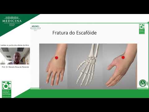 Vídeo: Lesões No Punho E Nas Mãos Relacionadas Ao Esporte: Uma Revisão