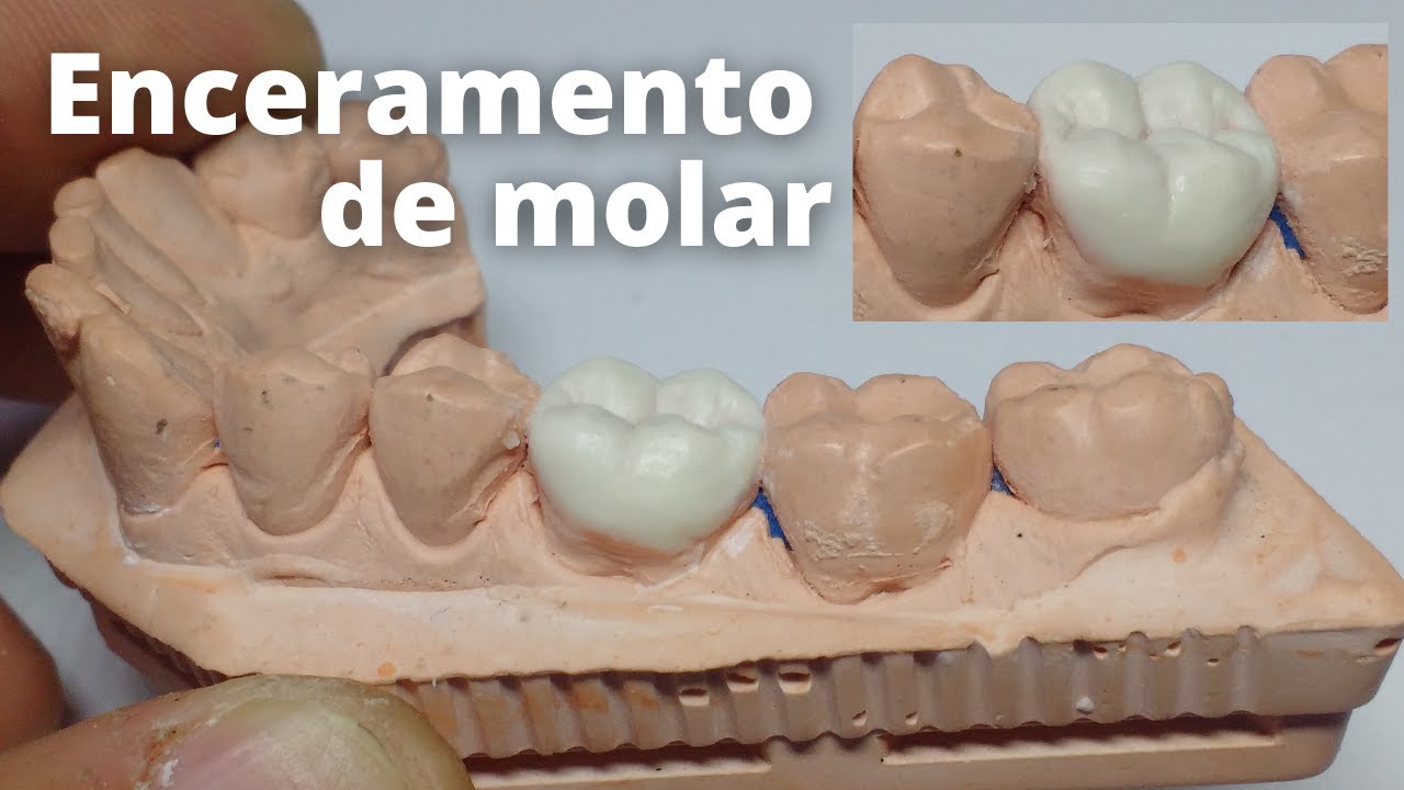 Enceramento de molar - Escultura para prótese dentária passo a passo