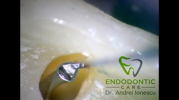 Using the Endo Cowboy system to remove a broken endodontic file - Dr. Andrei Ionescu