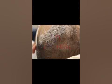 Мойка головы после пересадки головы // Медицинский Туризм - YouTube