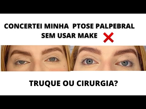 COMO CONCERTAR OLHO MENOR QUE O OUTRO: ELIMINE AGORA SUA PTOSE ...