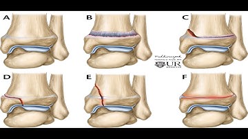 salter harris classification