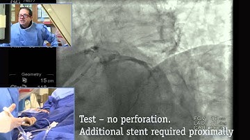 Complex PCI Case Study: Part 3 - Stent Deployment with Guide Support