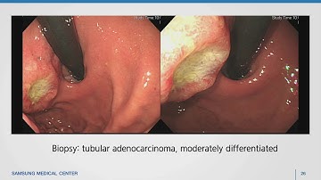 소화성 궤양 2015. 위궤양 십이지장궤양 peptic ulcer