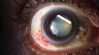 Corticosteroids induced cataract ?