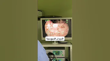 الديدان الدبوسية تعتبر من أكثر أنواع إصابات الع دوى المعوية انتشار ا على مستوى العالم 