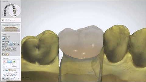 (German) 3Shape Dental System - Smile Composer 2.0 with Integrated Sculpt Toolkit