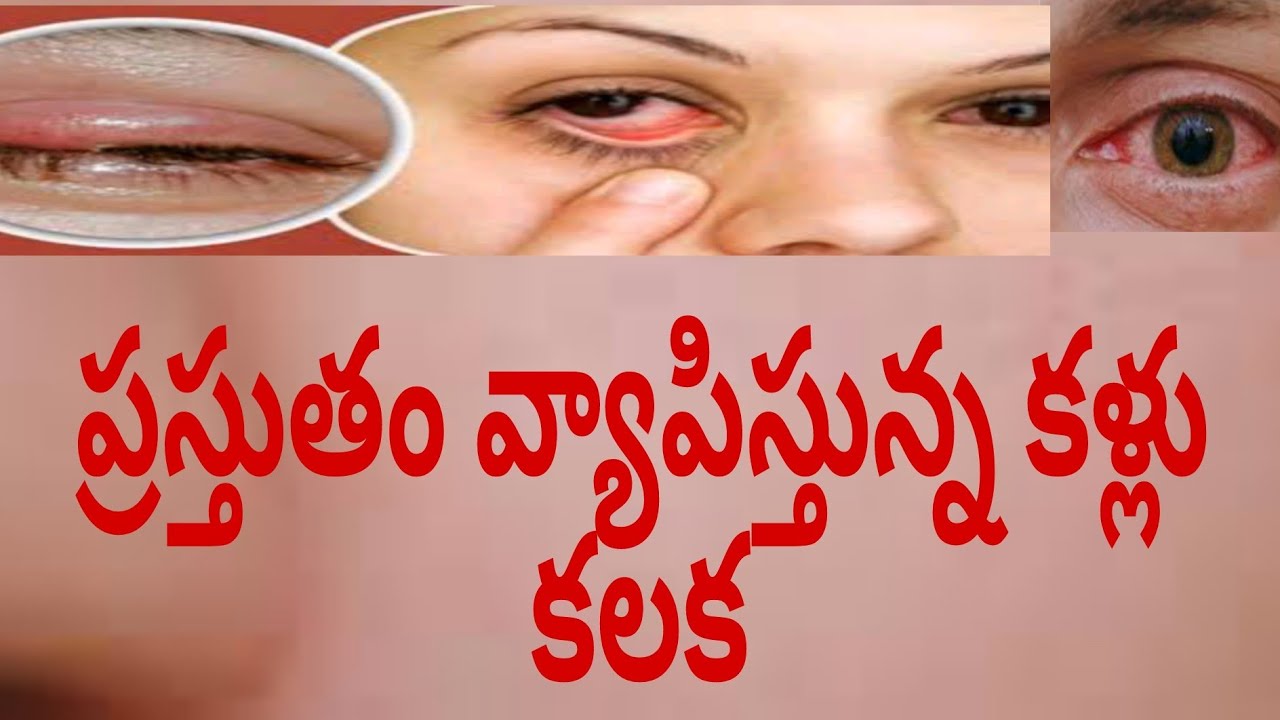 eye infection. YouTube