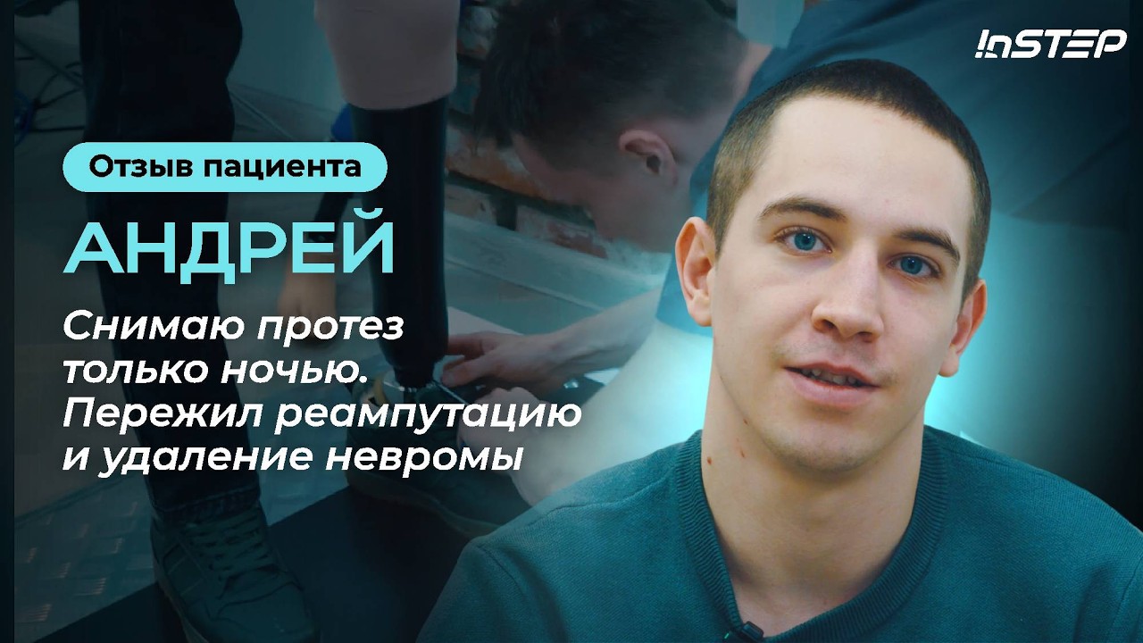 Не снимает протез по 15 часов. Удаление невромы. Отзыв пациента Андрея