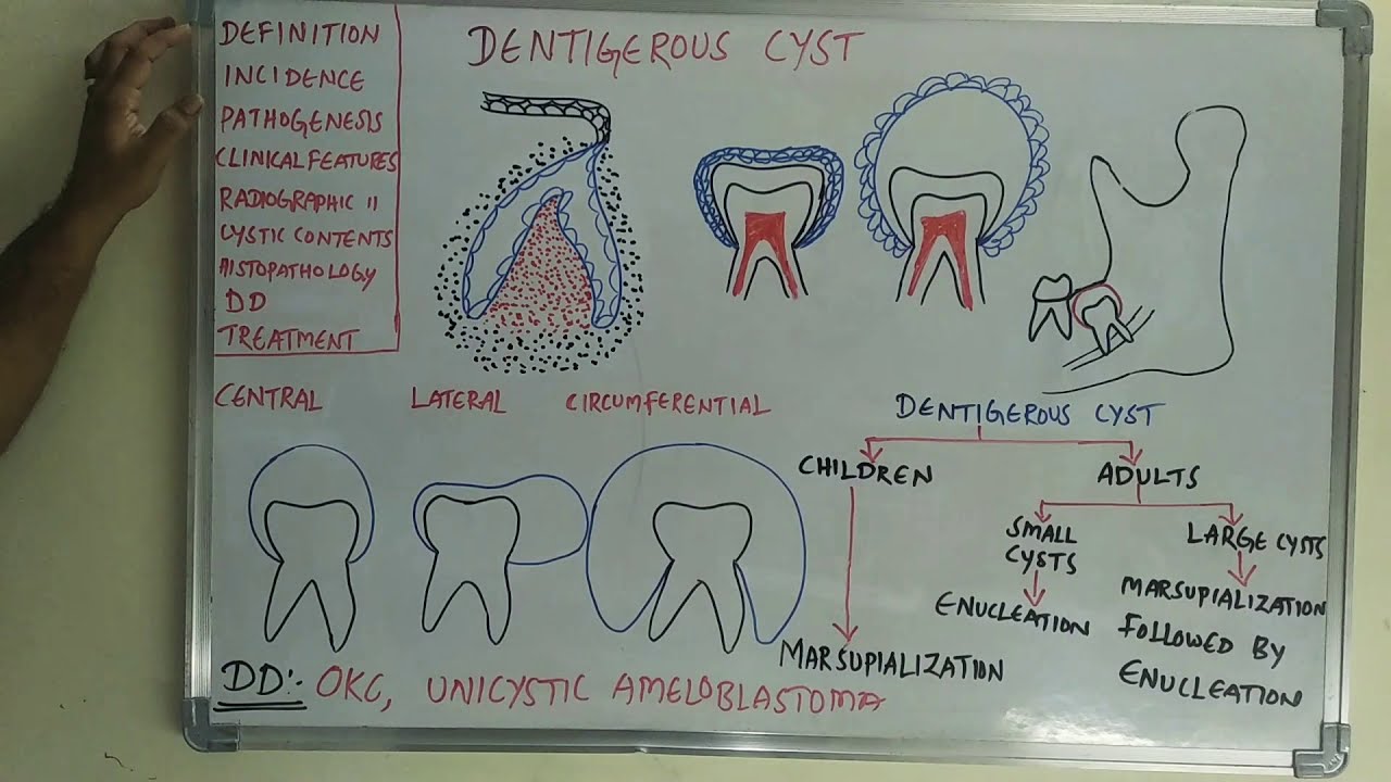 Dentigerous cyst YouTube