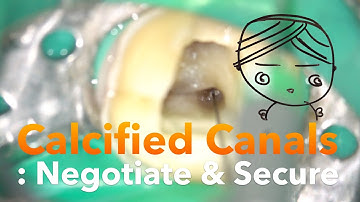 Calcified Canals : Negotiate & Secure in Mn 1st Molar