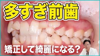 Orthodontic treatment for supernumerary teeth! We will explain in