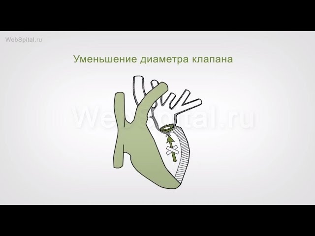 Минимально-инвазивная реконструкция митрального клапана